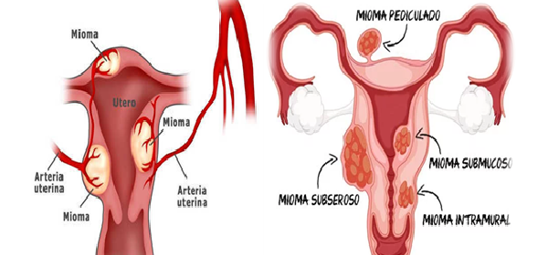como-eliminar-miomas-uterinos