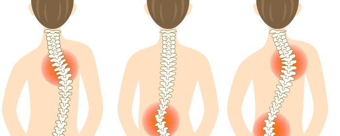 escoliosis