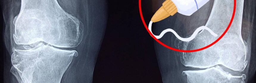 Pegamento Óseo que Repara Fracturas