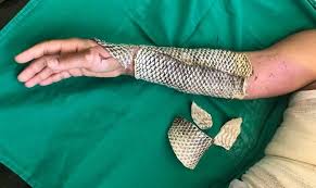 piel de tilapia para heridas
