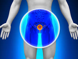 cáncer de próstata