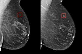 inteligencia artificial en la detección del cáncer de mama