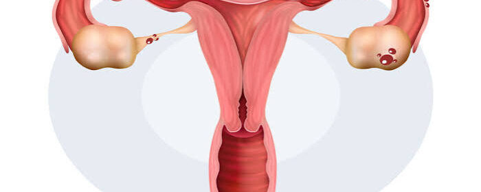 endometriosis